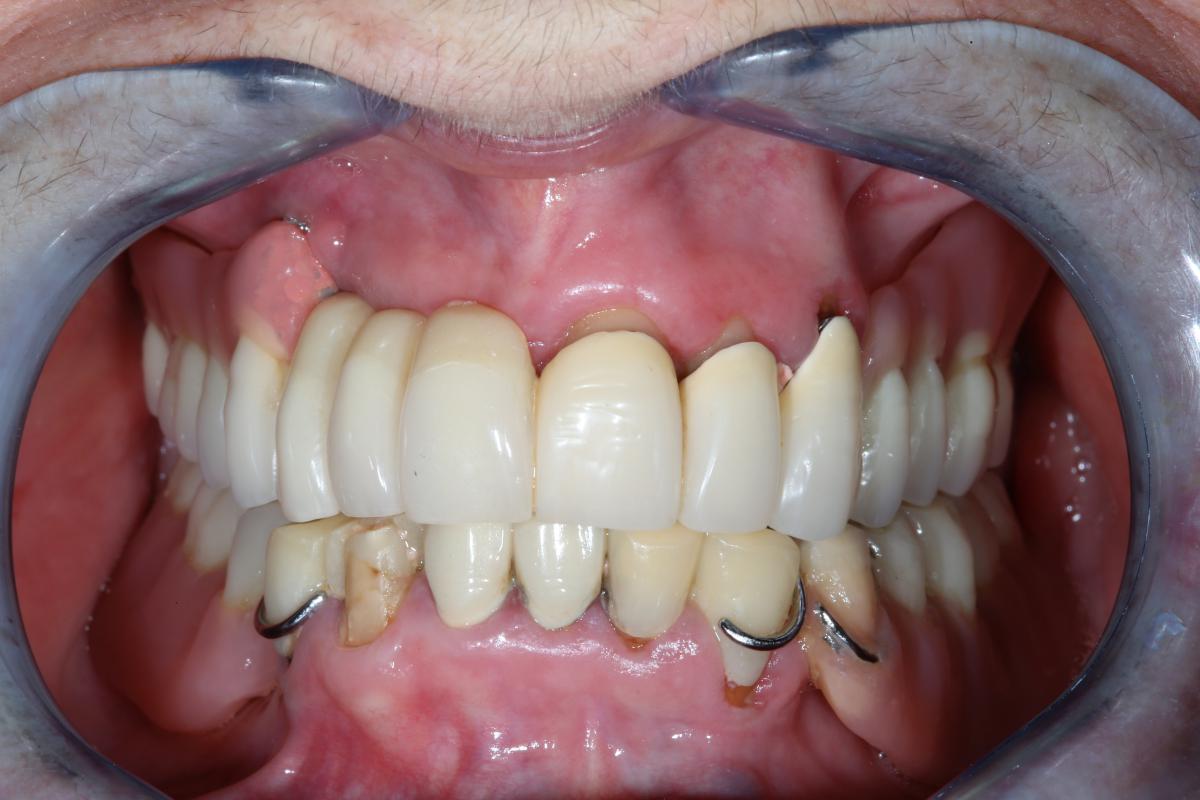 Overdenture (2)